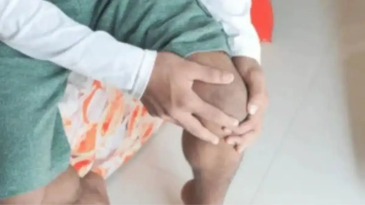 Condropatia patelar grau 3